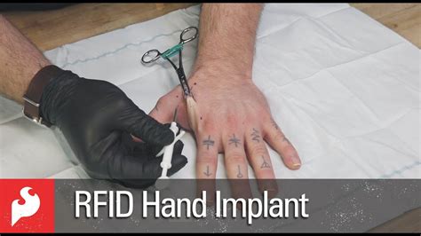 rfid chip in hand|rfid implants before and after.